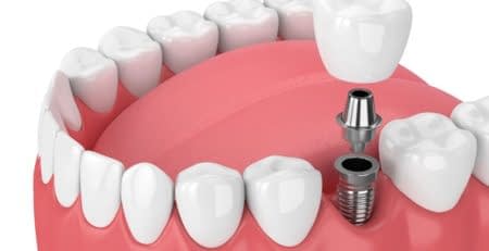 5 REASONS WHY DENTAL IMPLANTS ARE SO IMPORTANT