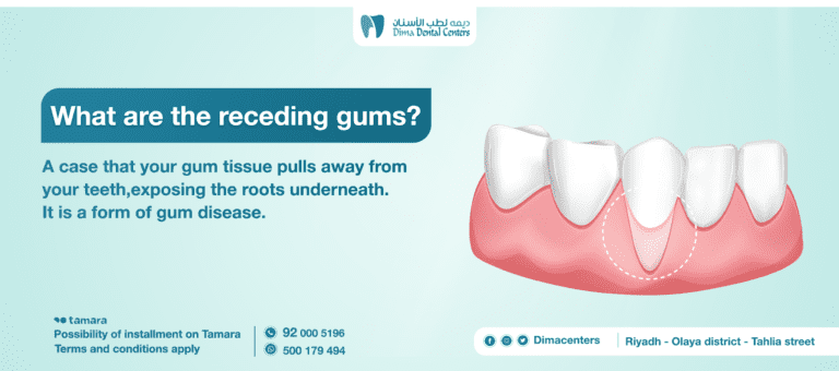 What you need to know about the causes of receding gums and treatment methods