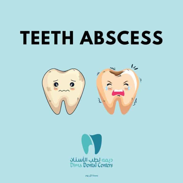 Tooth abscess and its treatment￼