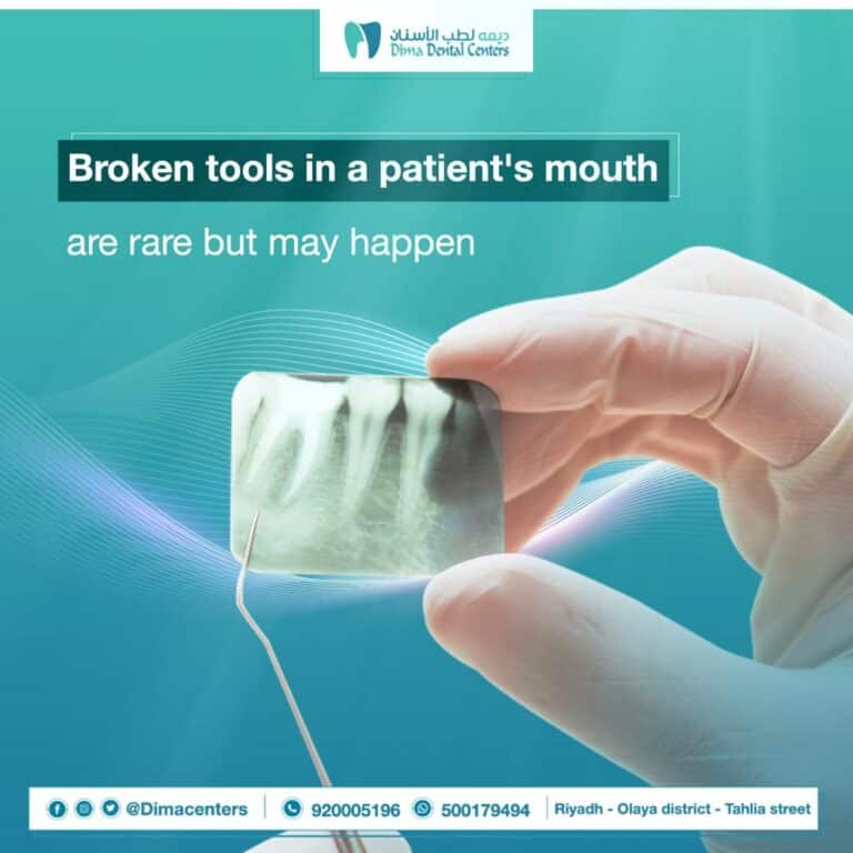 One of the accidents that occur at the dentist: breaking of dental tools inside the patient’s mouth