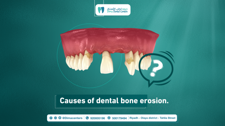 Dental Bone Erosion